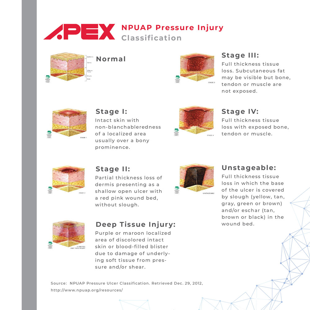 Apex Air Mattress Domus 2 ripple mattress for bed sores bubble mattress treatment for bed sores on buttocks mattress