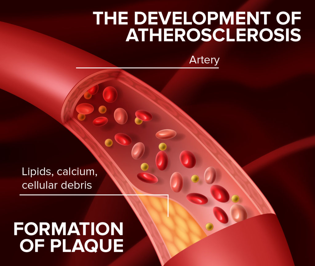 Formation of plaque and development of atheroscherosis.