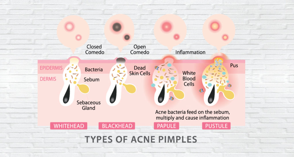 The Truth About Acne - Alpro Pharmacy