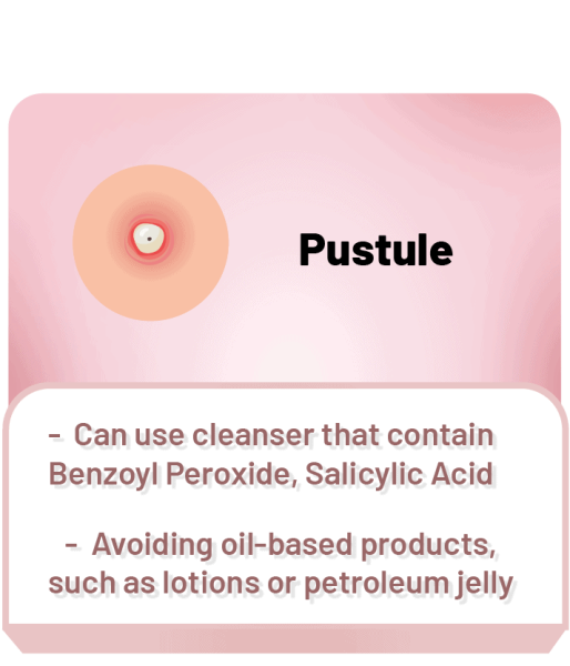 pustule acne